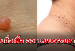 7 วิธีธรรมชาติ ทำได้ด้วยตัวเอง ด้วยของในครัว หลุดออกง่าย